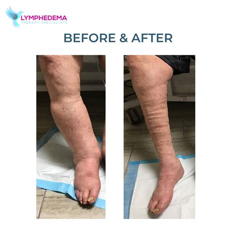 Photos Lymphedema Therapy Specialists