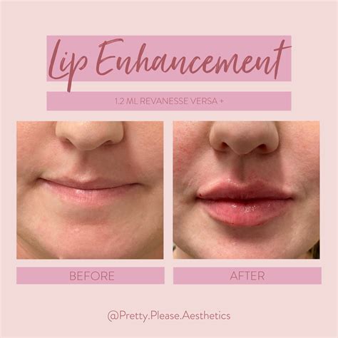 Lip Filler Before And After Lip Fillers Lip Implants Botox Fillers
