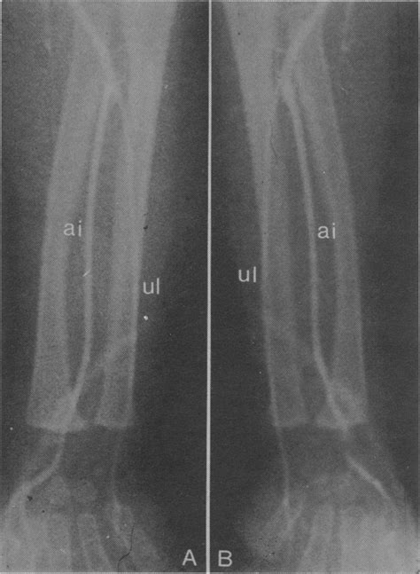 Right A And Left B Forearm Of Patient With Absent Radial Artery And