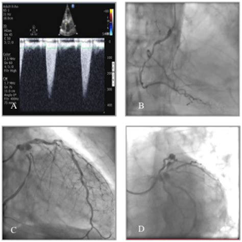 A Echocardiographic Evidence Of Severe Aortic Stenosis With Maximum