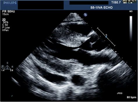 Echocardiographic Findings In Cardiac Amyloidosis Notable Left