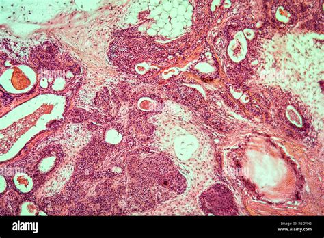 Parotid Gland High Resolution Stock Photography And Images Alamy