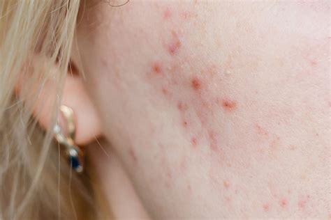 Can Seasonal Allergies Cause Acne Daily Subscriber