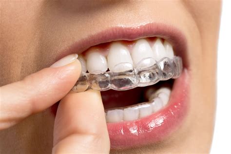 Orthodontics Australia Clear Aligner Attachments How Do They Work