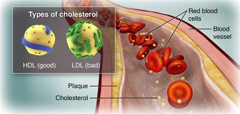 Soluble fiber is found in foods like vegetables, fruits. Cholesterol in the Blood