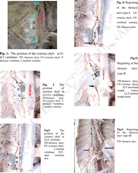 Pdf An Anatomical Study Of The Human Cisterna Chyli And Its Clinical