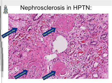 Hypertensive Nephrosclerosis Kidney Histology