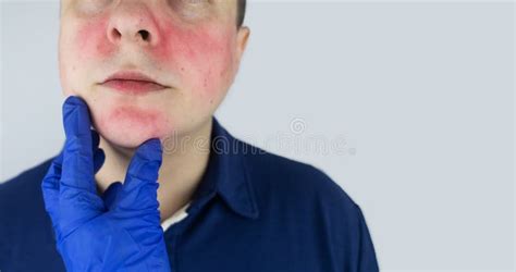 Rosacea Face The Man Suffers From Redness On Her Cheeks Couperose Of