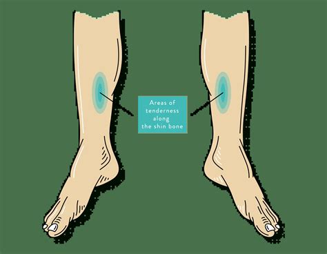 What Are Shin Splints And How To Treat Them The Foot Hub