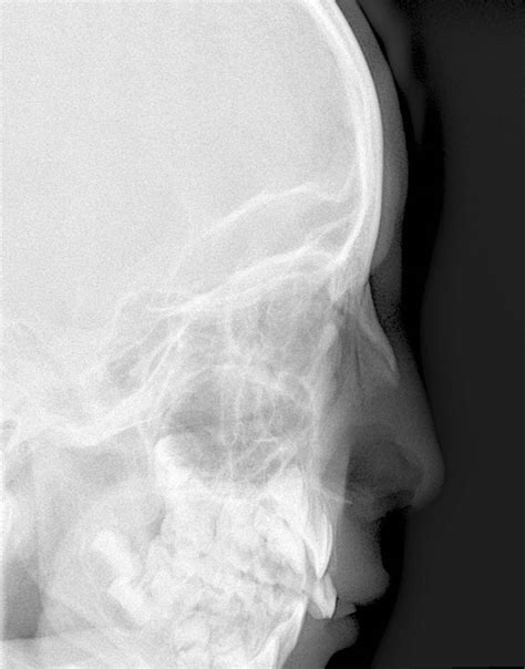 The image shows the dorsal aspect of nasal bones. Normal nasal bone radiograph (6-year-old) | Image ...