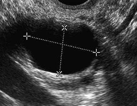 Ultrasound And Assessment Of Ovarian Cancer Risk Ajr