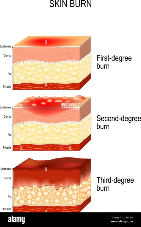 Skin Burn Three Degrees Of Burns Type Of Injury To Skin Step Of Burn