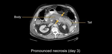 Abdominal Ct Necrotizing Pancreatitis • Litfl • Radiology Library