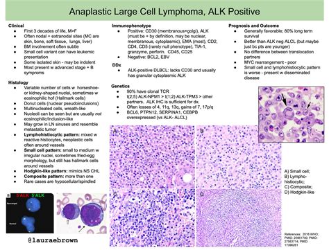 Anaplastic Large Cell Lymphoma Alk Clinical • Grepmed