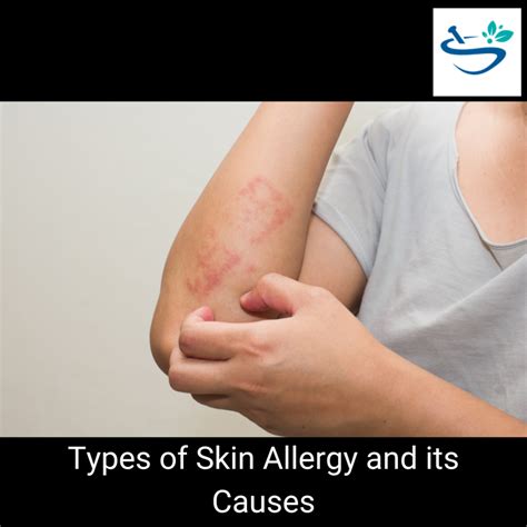 Understanding Different Types Of Skin Allergies A Comprehensive Guide Samurai Pharmacy