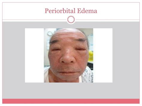 Periorbital Edema Causes Symptoms And Treatment