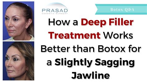 Slightly Sagging Jawline How Treatment With Volume Correction Works Better Than Botox Youtube