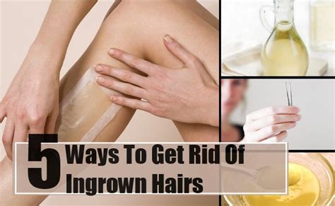 Best And Effective Ways To Get Rid Of Ingrown Hairs Find Home Remedy