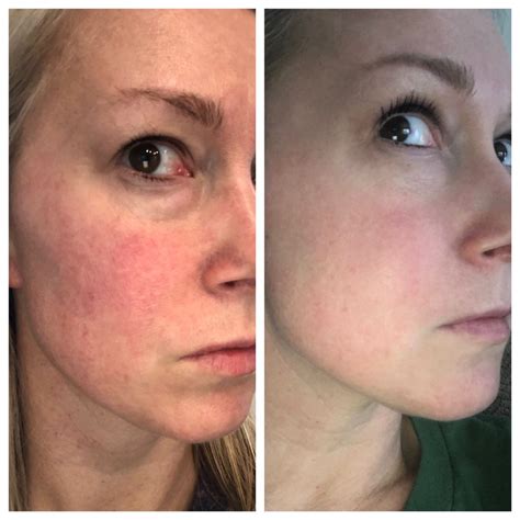 Ipl For Rosacea At Home Pantydroppermeme