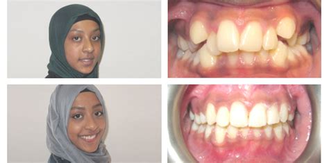 Rajmina Age 12 Moira Wong Orthodontics
