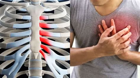 Symptoms Causes Tests And Treatment For Costochondritis