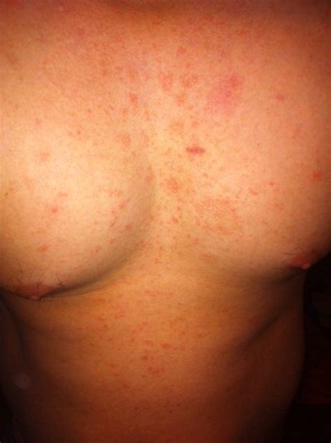 Rash On My Chest Pictures Photos