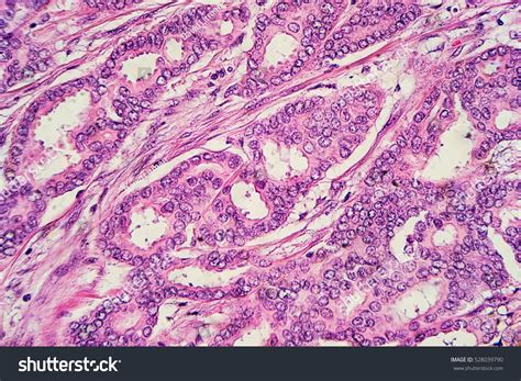 Breast Cancer Histology Microscopic Image Well Foto De Stock Editar