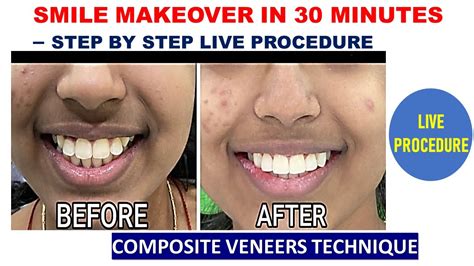 Smile Makeover In 30 Minutes Step By Step Live Procedure Composite