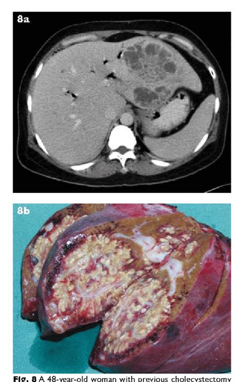 Pdf Management Of Pyogenic Liver Abscesses Percutaneous Or Open
