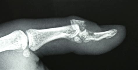 A Displaced Comminuted Intra Articular Fracture Of The Terminal Phalanx