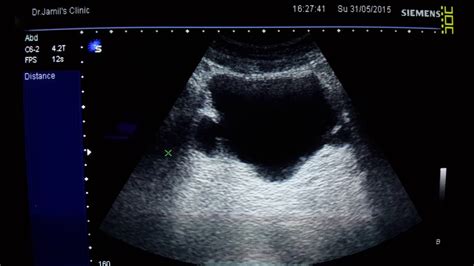 Diverticuli Of Urinary Bladder Ultrasound Youtube