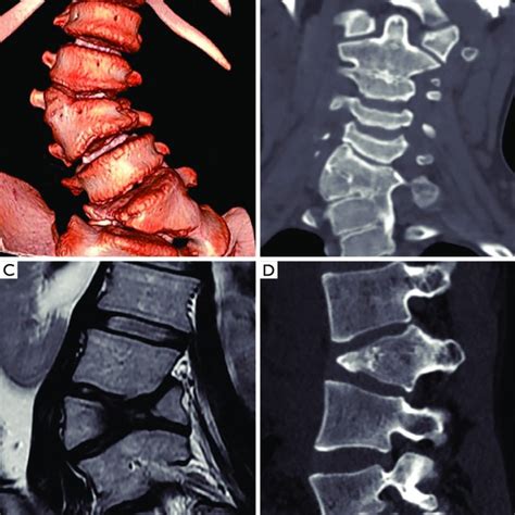 Ao Spine Thoracolumbar Fracture Classification Score A A