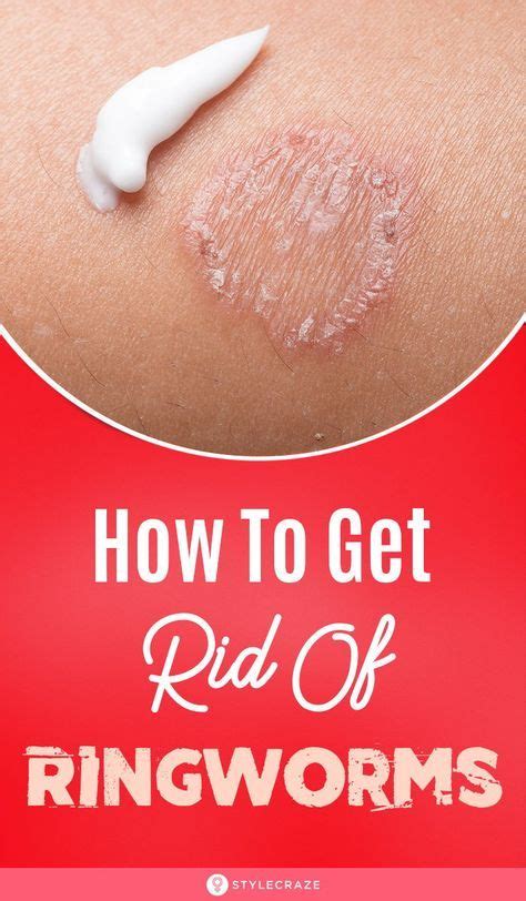 How To Get Rid Of Ringworms Top 15 Powerful Home Remedies Ringworm
