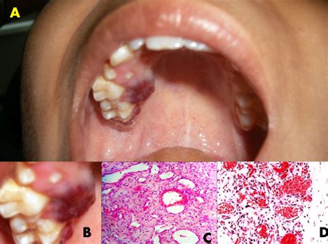 Capillary Hemangioma Of Posterior Palatal Mucosa