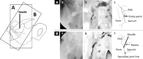 Figure 2 From Fluoroscopy Guided Sacroiliac Intraarticular Injection