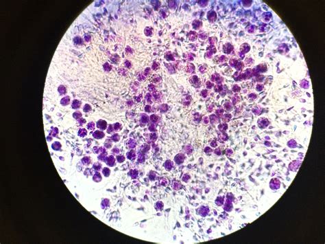 Leukocytes Westlake Ivf