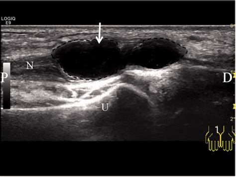 Ultrasound Images Of The Intraneural Ganglion Of The Ulnar Nerve At The