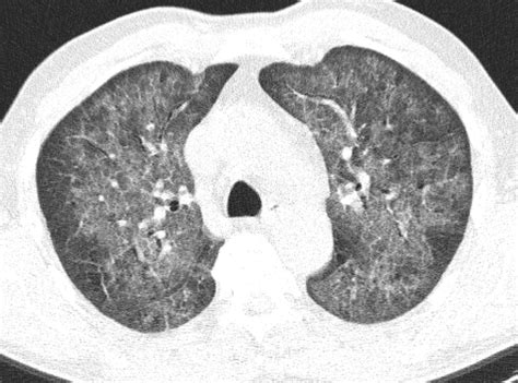 Pneumocystis Carnii Ct Sumers Radiology Blog