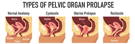Pelvic Organ Prolapse