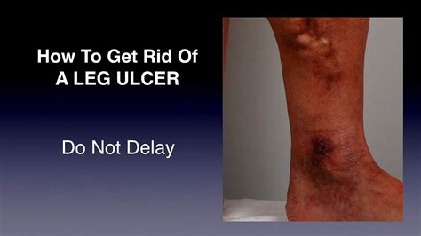 Leg Ulcers Treatment Ulcer Choices