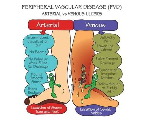 Peripheral Arterial Disease Vs Venous Disease Pelajaran
