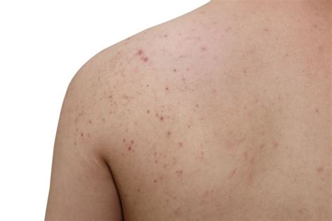 Causes Of Acne On Arms And Back Acne Causes Body Acne Shoulder Acne