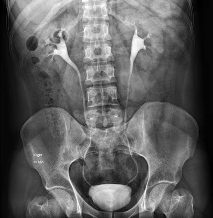 Intravenous Urography Radiology Reference Article Radiopaedia Org