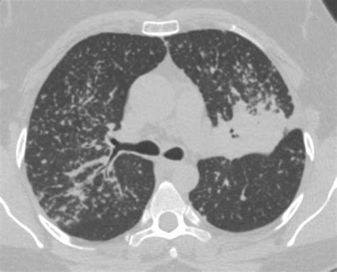Miliary Tb With Tree In Bud Appearance Chest Case Studies Ctisus Ct