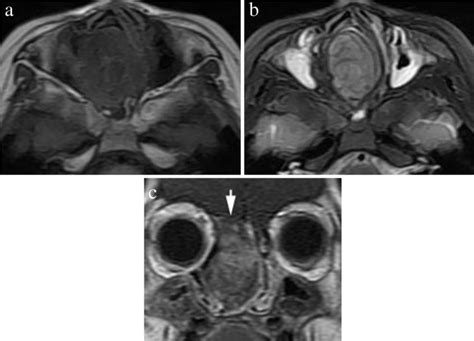 Mr Imaging Of Sinonasal Cavity A An Axial T Weighted Mri Revealed A