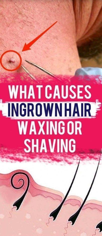 What Causes Ingrown Hair Waxing Or Shaving All About Woman Life Style Ingrownhairessentialoil