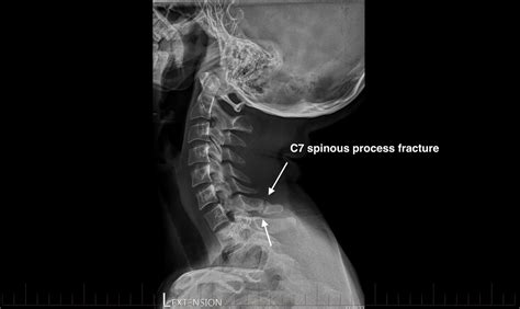 Radiology Review C Spinous Process Fracture Axis Sports Med