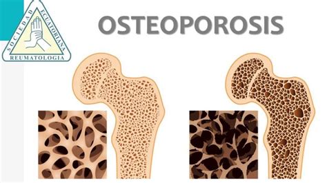 Osteoporosis · Sociedad Ecuatoriana De Reumatología