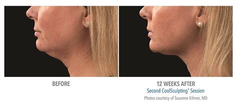 Get Rid Of Double Chin Without Surgery Specialist Skin Clinic Cardiff
