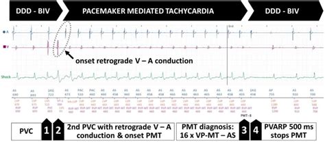 Example Of Pacemaker Mediated Tachycardia In The Context Of Premature